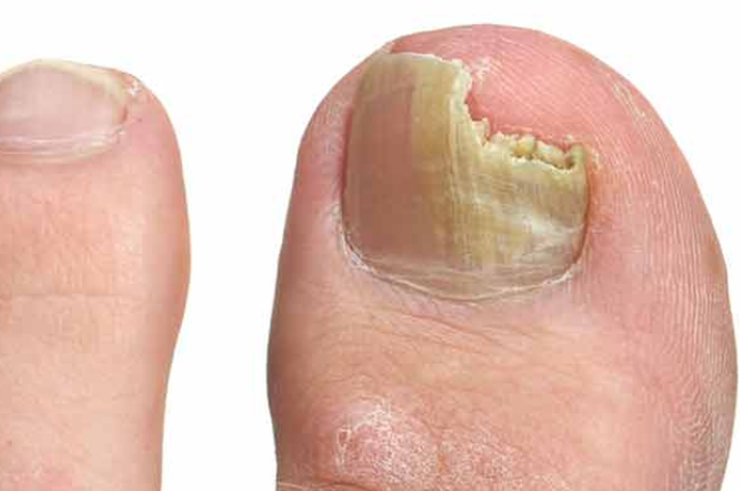 Nail Infections - Crumlin Podiatry